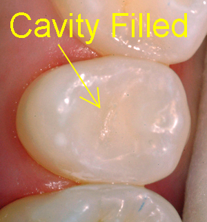 composite filling